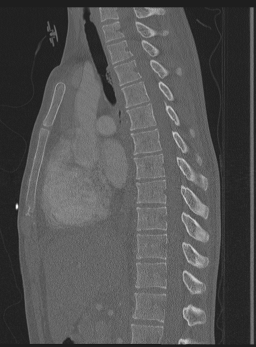 Abdominal multi-trauma - devascularised kidney and liver, spleen and pancreatic lacerations (Radiopaedia 34984-36486 Sagittal bone window 35).png