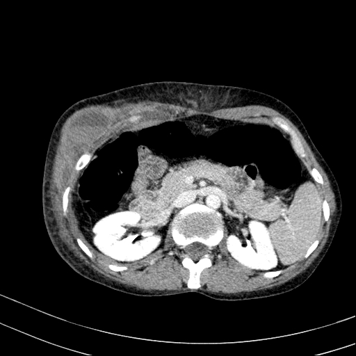 File:Abdominal wall hematoma with active bleeding (Radiopaedia 83915-99117 Axial C+ portal venous phase 17).jpg
