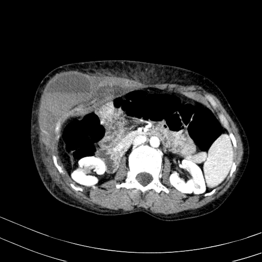 Abdominal wall hematoma with active bleeding (Radiopaedia 83915-99117 Axial renal cortical phase 27).jpg