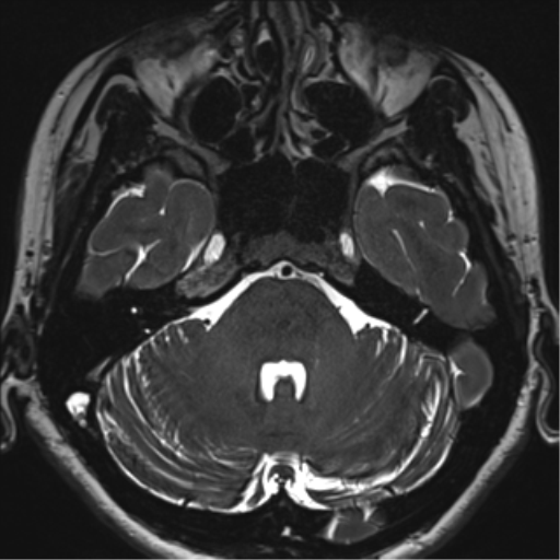 File:Abducens nerve palsy (Radiopaedia 51069-56648 Axial T2 fat sat 29).png