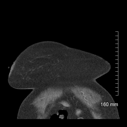 Aberrant right subclavian artery stenosis (Radiopaedia 52656-58670 B 10).jpg