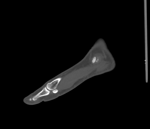 File:Accessory navicular bone (Radiopaedia 54999-61314 Sagittal non-contrast 14).jpg