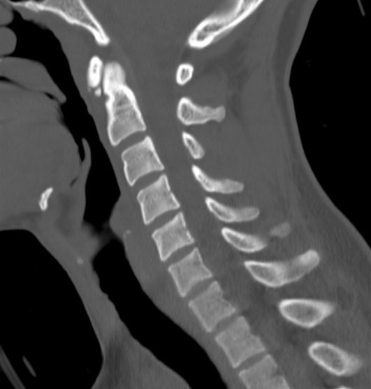 File:Accessory ossicle of the anterior arch of C1 vertebra (Radiopaedia 58149-65211 Sagittal bone window 10).jpg