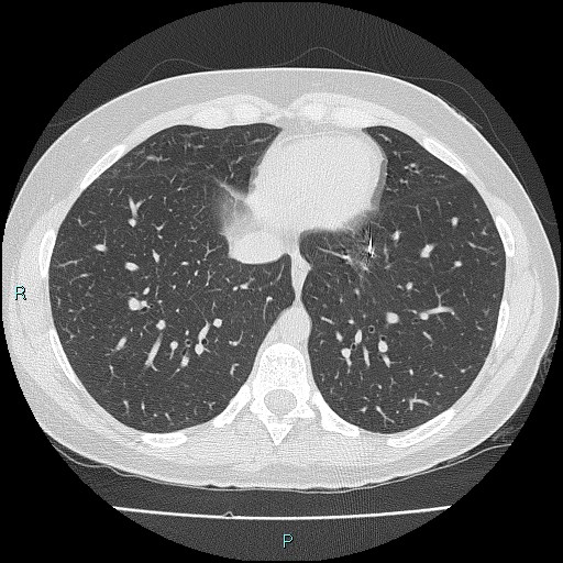 File:Accidental foreign body aspiration (seamstress needle) (Radiopaedia 77740-89983 Axial lung window 48).jpg