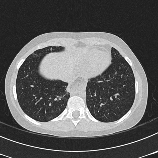 Achalasia (Radiopaedia 14946-14878 Axial lung window 61).jpg