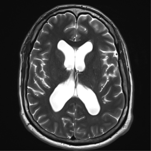 File:Achondroplasia (Radiopaedia 65109-74105 Axial T2 21).png