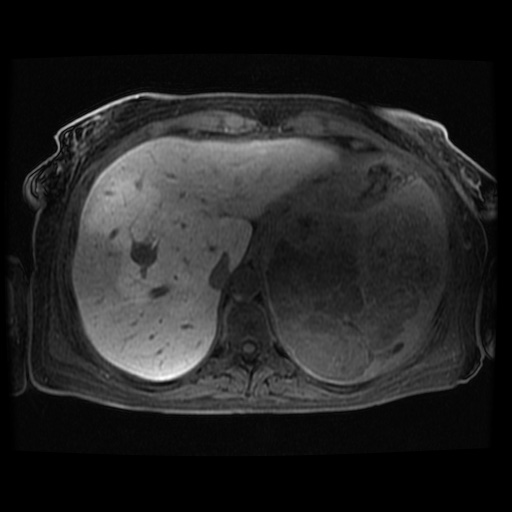 Acinar cell carcinoma of the pancreas (Radiopaedia 75442-86668 Axial late phase (~30 mins) 109).jpg