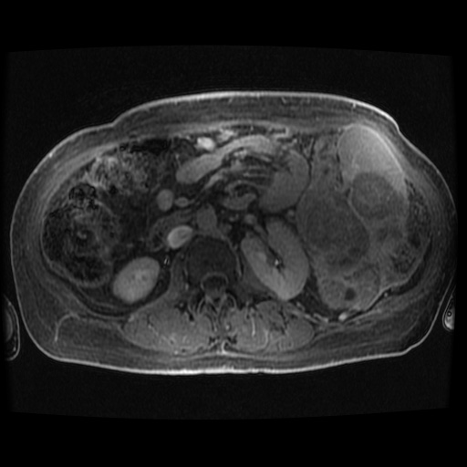 Acinar cell carcinoma of the pancreas (Radiopaedia 75442-86668 Axial late phase (~30 mins) 27).jpg