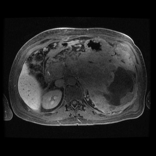 Acinar cell carcinoma of the pancreas (Radiopaedia 75442-86668 Axial late phase (~30 mins) 66).jpg