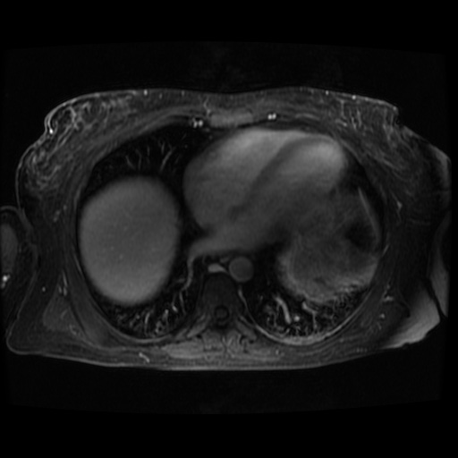 Acinar cell carcinoma of the pancreas (Radiopaedia 75442-86668 D 139).jpg