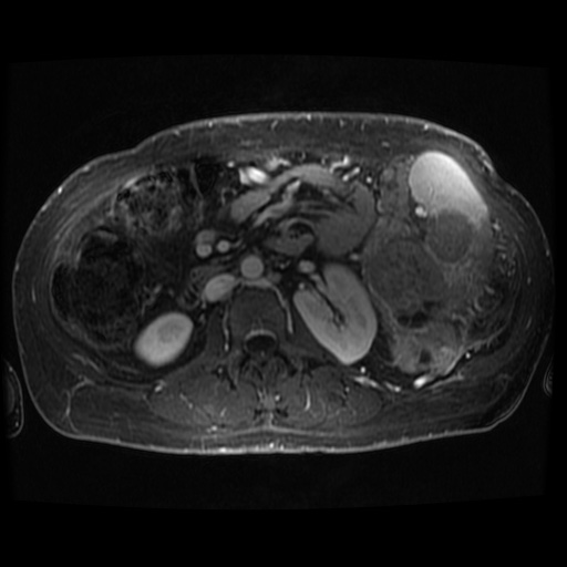 Acinar cell carcinoma of the pancreas (Radiopaedia 75442-86668 D 26).jpg