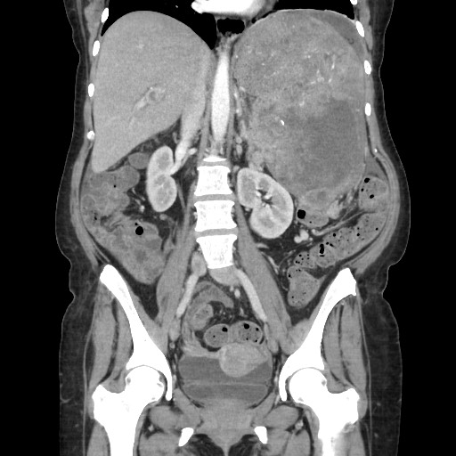 File:Acinar cell carcinoma of the pancreas (Radiopaedia 75442-86669 Coronal C+ portal venous phase 71).jpg