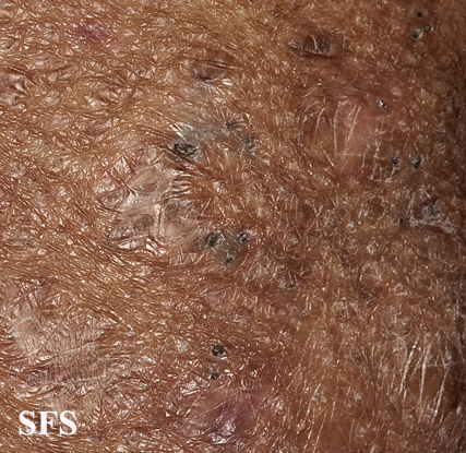 File:Acne (Dermatology Atlas 24).jpg