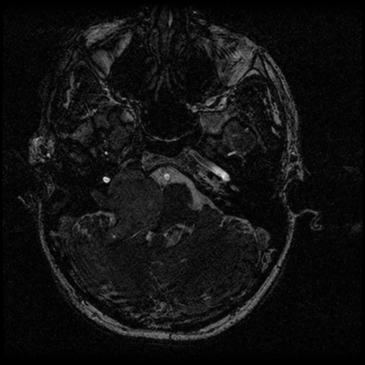 Acoustic schwannoma - eroding petrous apex (Radiopaedia 39674-42004 Axial T2 20).png