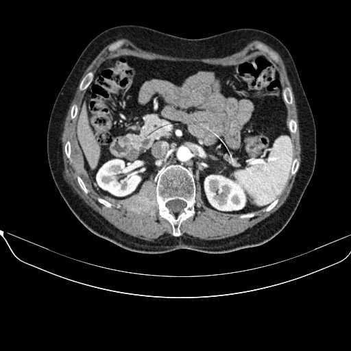 File:Acquired adrenal hyperplasia - due to thymic carcinoid tumor (Radiopaedia 21269-21184 C+ arterial phase 44).jpg