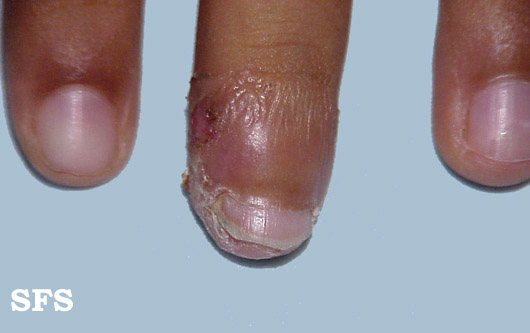 File:Acrodermatitis Continua (Dermatology Atlas 1).jpg