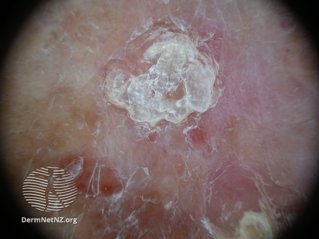 File:Actinic Keratoses affecting the legs and feet (DermNet NZ lesions-ak-legs-506).jpg