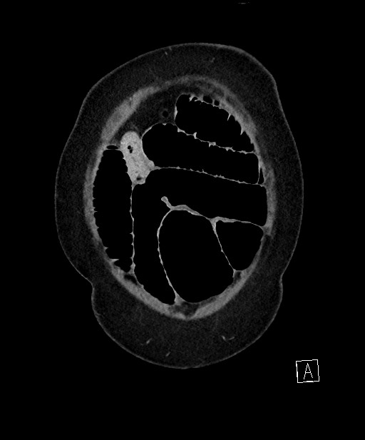 Active Crohn disease (Radiopaedia 59394-66750 Coronal C+ portal venous phase 12).jpg