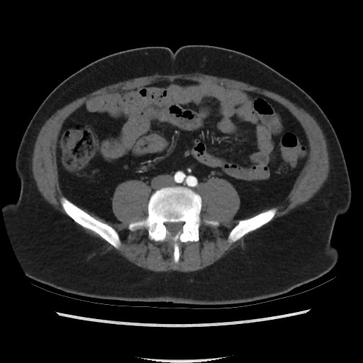 Active colonic bleed on CT (Radiopaedia 49765-55025 Axial C+ arterial phase 52).jpg