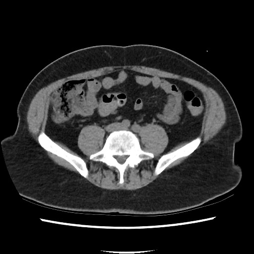 Active colonic bleed on CT (Radiopaedia 49765-55025 Axial non-contrast 54).jpg