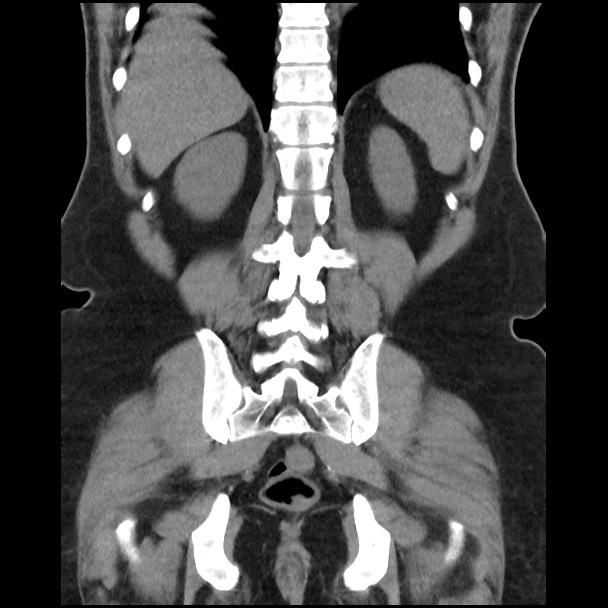 Active colonic bleed on CT (Radiopaedia 49765-55025 Coronal non-contrast 42).jpg