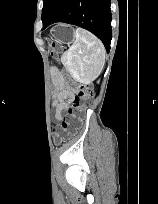 Active crohn disease (Radiopaedia 87133-103397 Sagittal C+ arterial phase 76).jpg