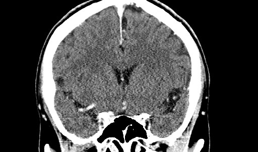 File:Active neurocysticercosis before and after therapy (Radiopaedia 71710-82099 Coronal C+ delayed 32).jpg