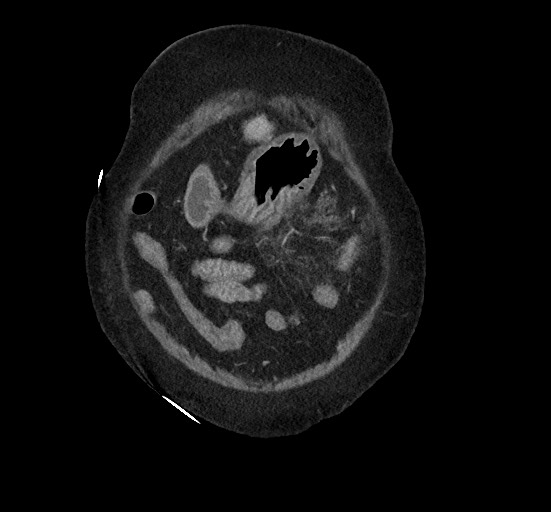 File:Active renal extravasation with large subcapsular and retroperitoneal hemorrhage (Radiopaedia 60975-68796 Coronal C+ portal venous phase 30).jpg
