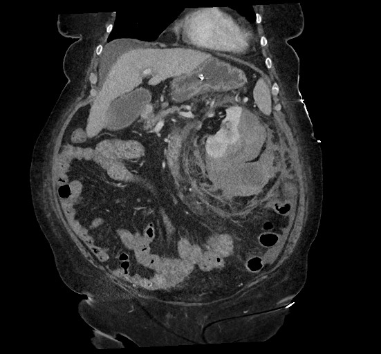 Active renal extravasation with large subcapsular and retroperitoneal hemorrhage (Radiopaedia 60975-68796 Coronal C+ portal venous phase 56).jpg