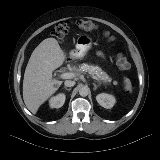Acute-on-chronic pancreatitis (Radiopaedia 67286-76656 Axial C+ portal venous phase 24).jpg
