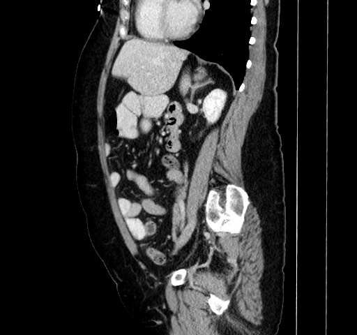 Acute appendicitis, heterotaxy syndrome (Radiopaedia 66884-76202 Sagittal C+ portal venous phase 85).jpg