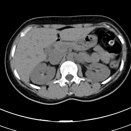 Acute appendicitis (Radiopaedia 30261-30888 Axial non-contrast 17).jpg