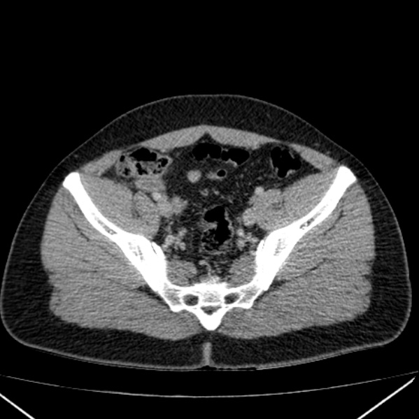 Acute appendicitis (Radiopaedia 38255-40270 Axial C+ portal venous phase 89).jpg