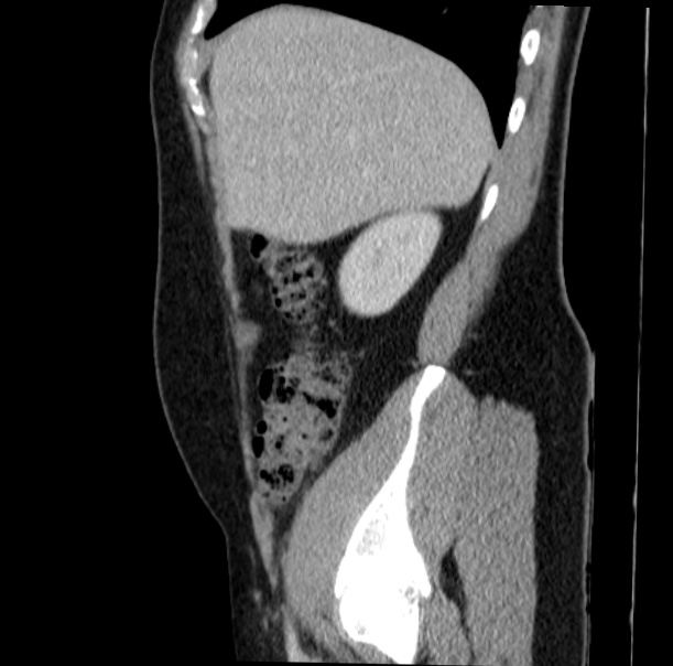 Acute appendicitis (Radiopaedia 38255-40270 Sagittal C+ portal venous phase 20).jpg