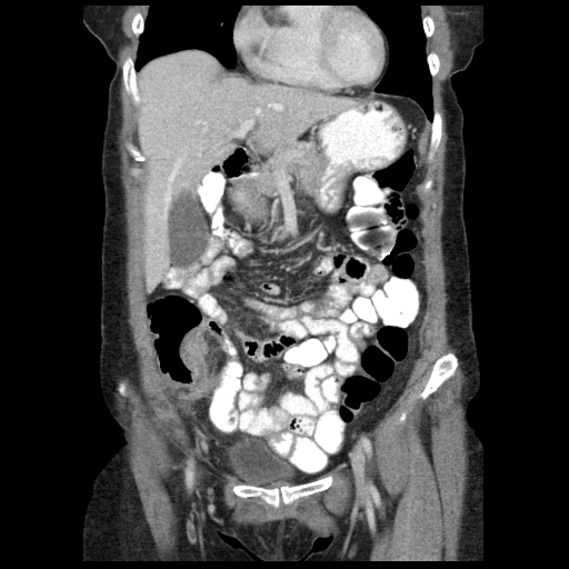 Acute appendicitis (Radiopaedia 52672-58589 Coronal C+ portal venous phase 21).jpg