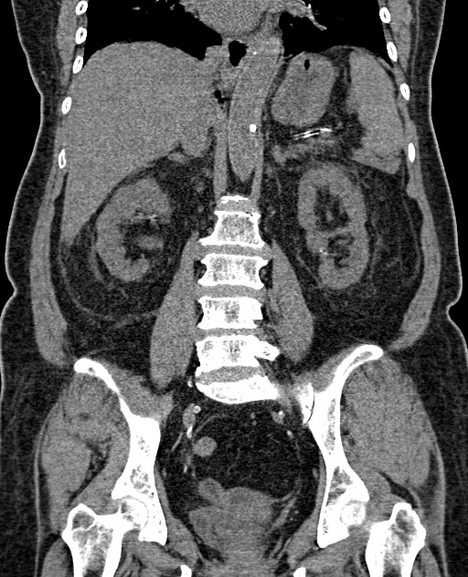 Acute appendicitis (Radiopaedia 58627-65818 Coronal non-contrast 46).jpg