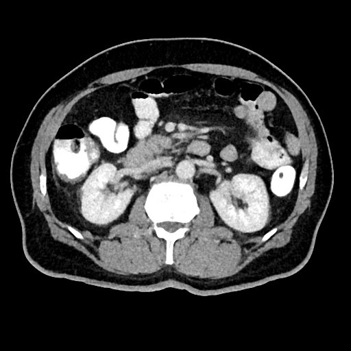 File:Acute appendicitis (Radiopaedia 77016-88960 Axial C+ portal venous phase 60).jpg