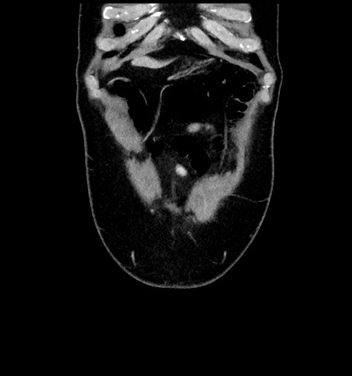 Acute appendicitis (Radiopaedia 77016-88960 Coronal C+ portal venous phase 20).jpg