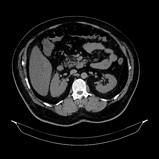 Acute appendicitis (Radiopaedia 79950-93224 Axial non-contrast 41).jpg