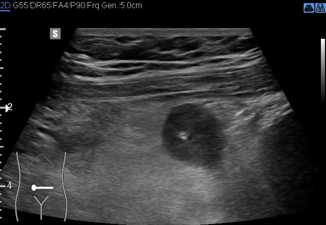 File:Acute appendicitis (Radiopaedia 85193-100745 D 174).jpg