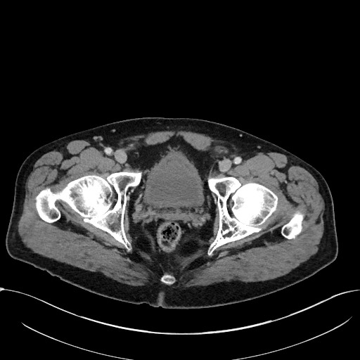 File:Acute appendicitis - large appendicoliths (Radiopaedia 61805-69820 Axial 92).jpg