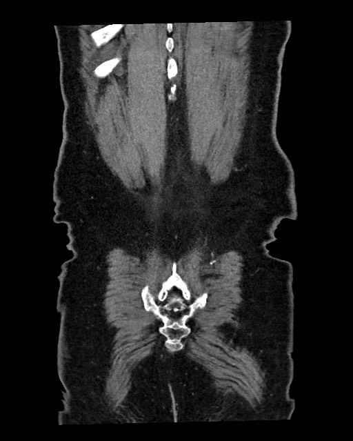 Acute appendicitis - large appendicoliths (Radiopaedia 61805-69820 Coronal C+ portal venous phase 124).jpg