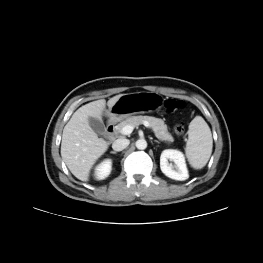 Acute appendicitis and COVID 19 pneumonia (Radiopaedia 76604-88380 Axial C+ portal venous phase 26).jpg