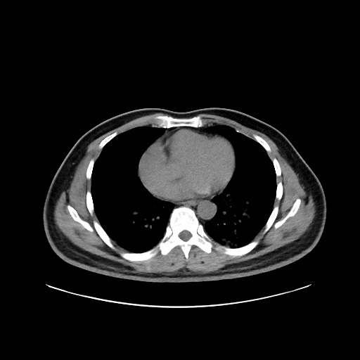 Acute appendicitis and COVID 19 pneumonia (Radiopaedia 76604-88380 Axial non-contrast 34).jpg