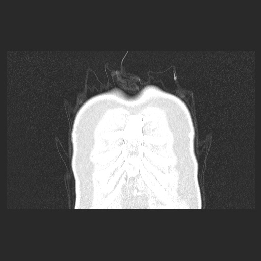 Acute appendicitis and COVID 19 pneumonia (Radiopaedia 76604-88380 G 6).jpg