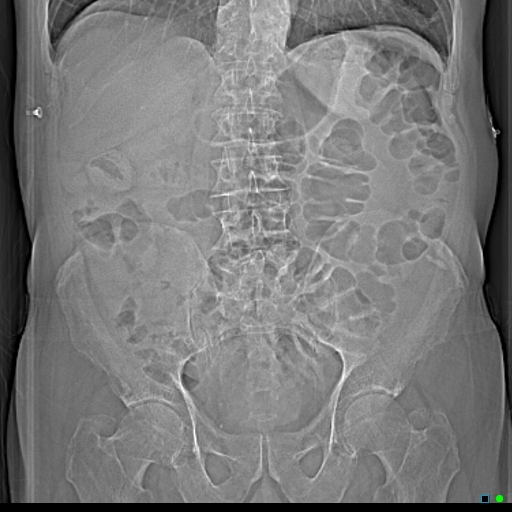 File:Acute appendicitis arising from a malrotated cecum (Radiopaedia 19970-19997 scout 1).jpg