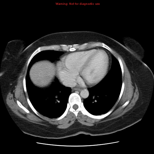 Acute appendicitis complicated by ovarian vein thrombophlebitis (Radiopaedia 16172-15851 Axial C+ portal venous phase 9).jpg
