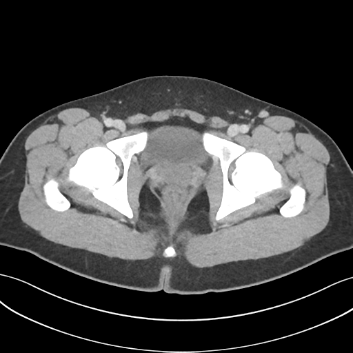 Acute appendicitis with appendicoliths (Radiopaedia 50186-55532 Axial C+ portal venous phase 81).png