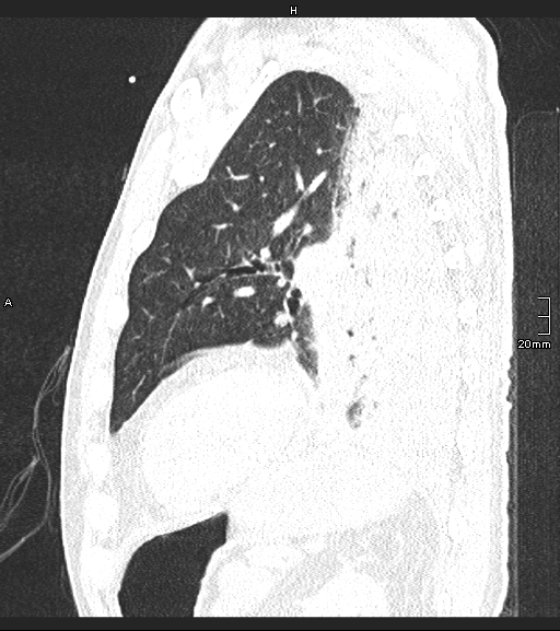 Acute aspiration pneumonitis (Radiopaedia 55642-62166 Sagittal lung window 41).jpg