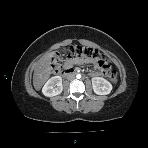 File:Acute bilateral pyelonephritis (Radiopaedia 37146-38881 Axial C+ arterial phase 92).jpg